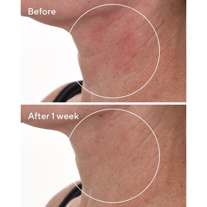 Murad Cellular Hydration Repair Serum 30 ml reparerende serum viser før og etter resultat med mindre rødhet på halsen