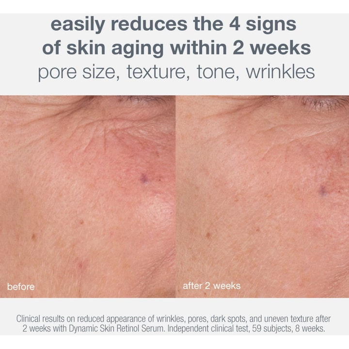 Dermalogica Skin Aging Solutions 70 ml ansiktsserum med retinol viser før- og etterbilder med reduserte rynker og porer.