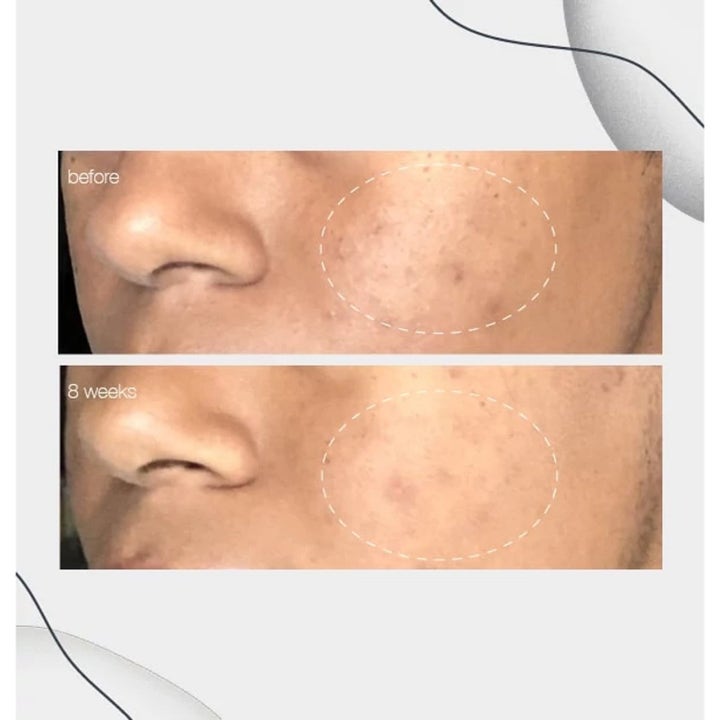 Dermalogica PowerBright Dark Spot Serum Duo før og etter bilder som viser reduserte mørke flekker over 8 uker