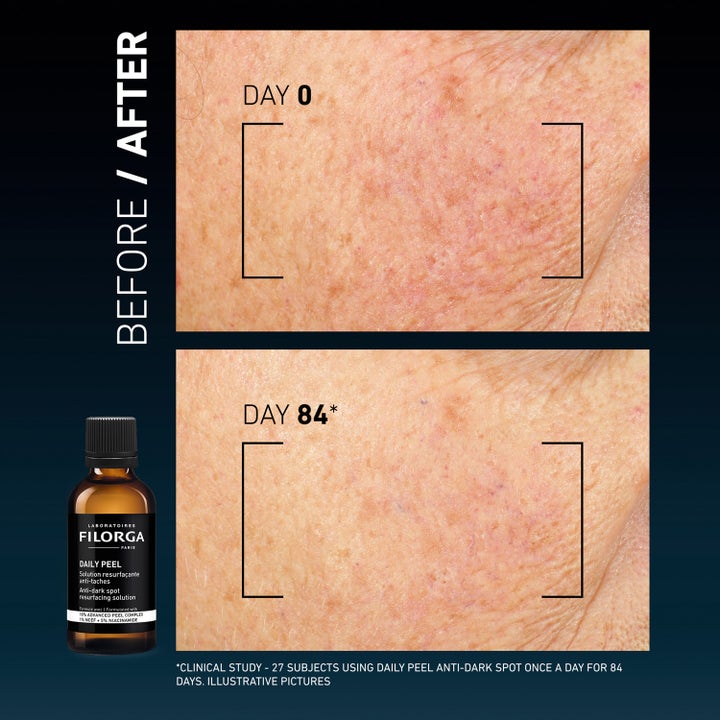 Filorga Clinical Home Peel Dark Spot 50 ml korrigerer pigmentflekker vist med før og etter bilder over 84 dager.