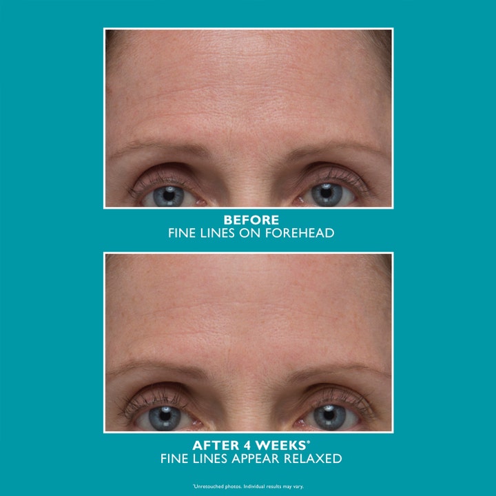 Peter Thomas Roth Peptide Skinjection Amplified Wrinkle-Fix Serum 30 ml som viser glattere panne etter 4 uker