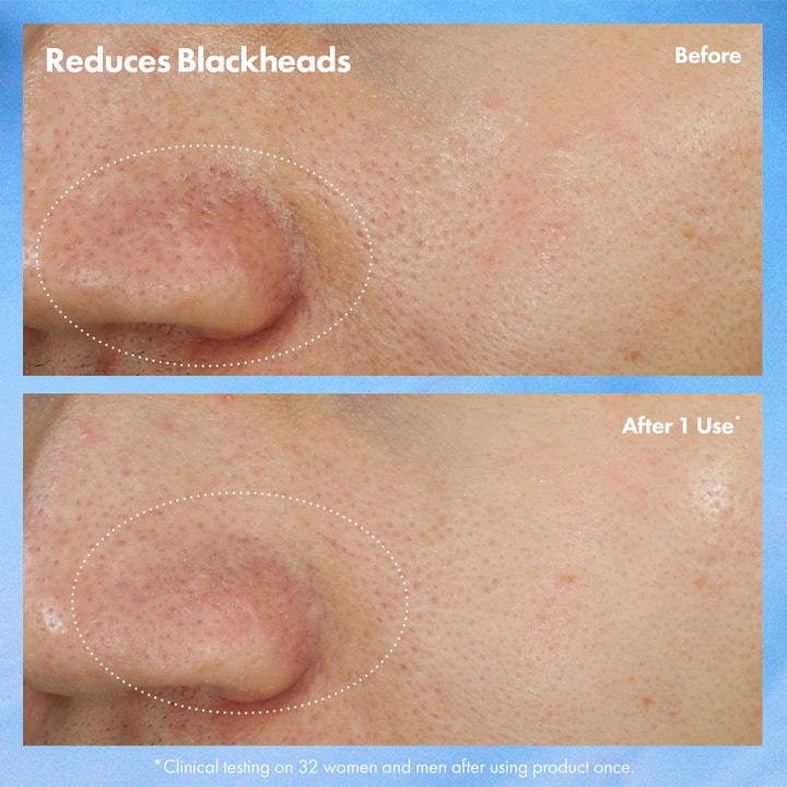 Origins Clear Improvement Blackhead Clearing Mask-To-Scrub 75 ml viser før og etter bilder som reduserer hudormer