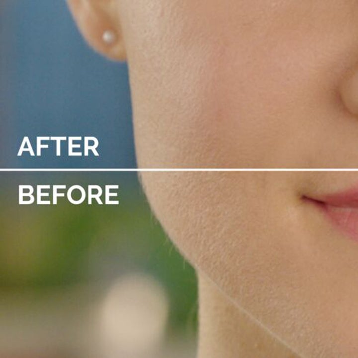 Flawless Flawless Face Blush 4.0 1 stk hårbortfjerning viser før- og etterbilde av fjerning av ansiktshår for glatt hud.