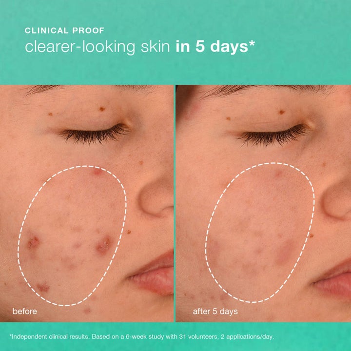 Dermalogica Breakout Biotic Moisturizer Duo hudpleie før og etter bilde som viser klinisk bevist klarere hud.