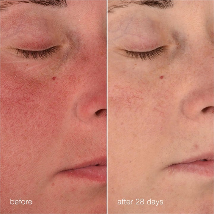 Dermalogica Stabilizing Repair Cream Duo før og etter 28 dager som demper rødhet og beroliger sensitiv hud