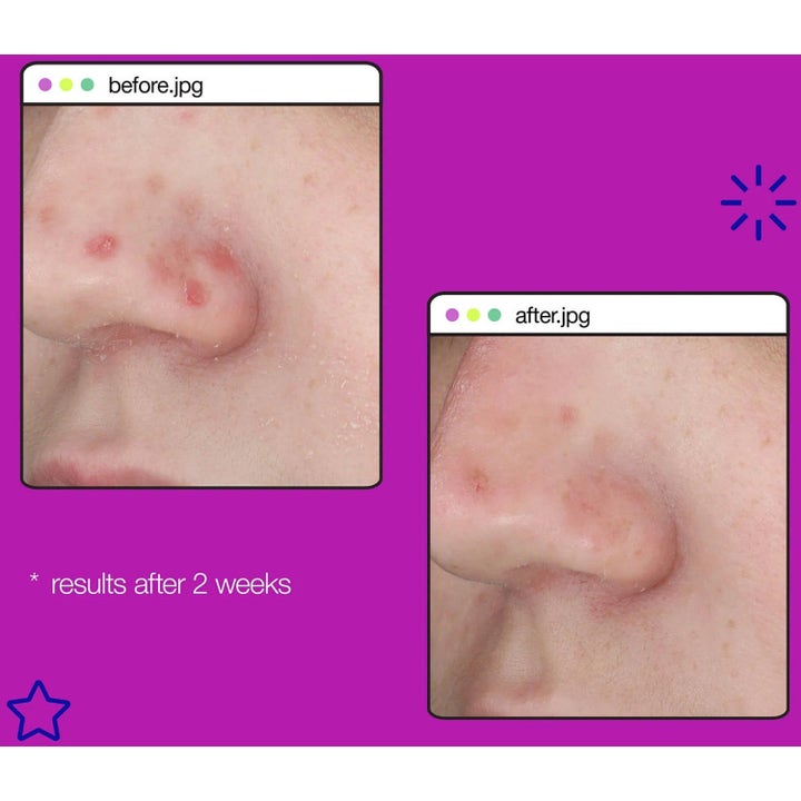 Dermalogica Post-Breakout Fix Duo 2x15 ml før og etter bilder som viser reduserte merker etter kviser på nesen.