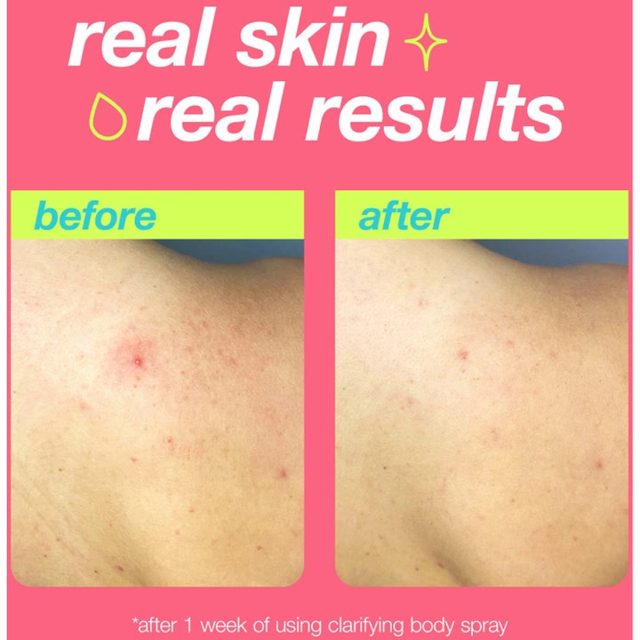 Dermalogica Clarifying Body Spray 177 ml mot urenheter viser før og etter-bilder med synlig klarere hud.