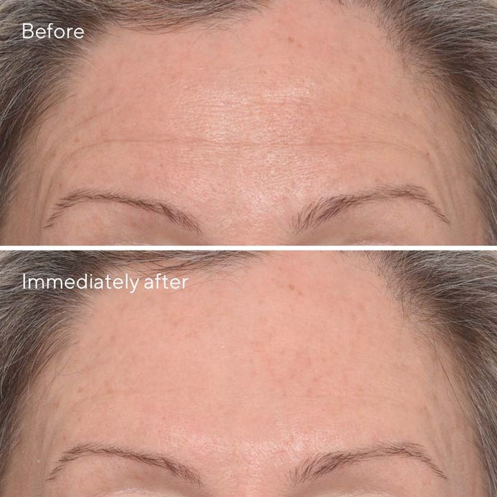 Murad Resurgence Targeted Wrinkle Corrector 15 ml serum før og etter bilde av rynker i pannen