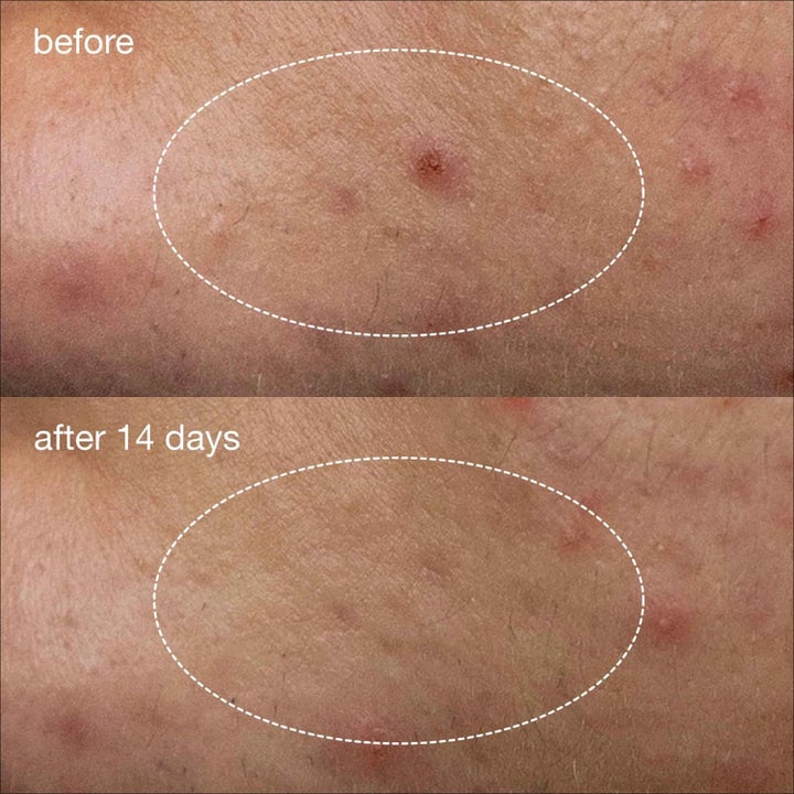 Dermalogica Deep Acne Liquid Patch Duo 2x15 ml med niacinamid viser før og etter resultat på akne