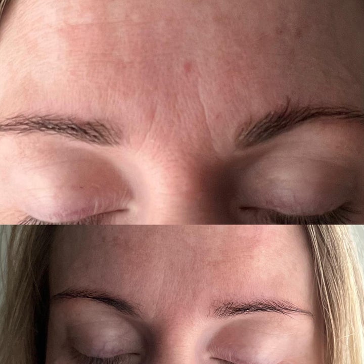 Dana Nel Facial Beauty Tape 1 stk kinesiologiteip for ansikt viser før og etter resultat på rynker i pannen