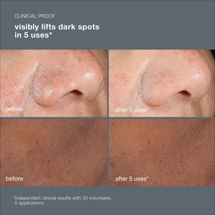 Dermalogica PowerBright Dark Spot Peel 50 ml ansiktspeeling viser før og etter resultat på mørke flekker etter 5 bruk.