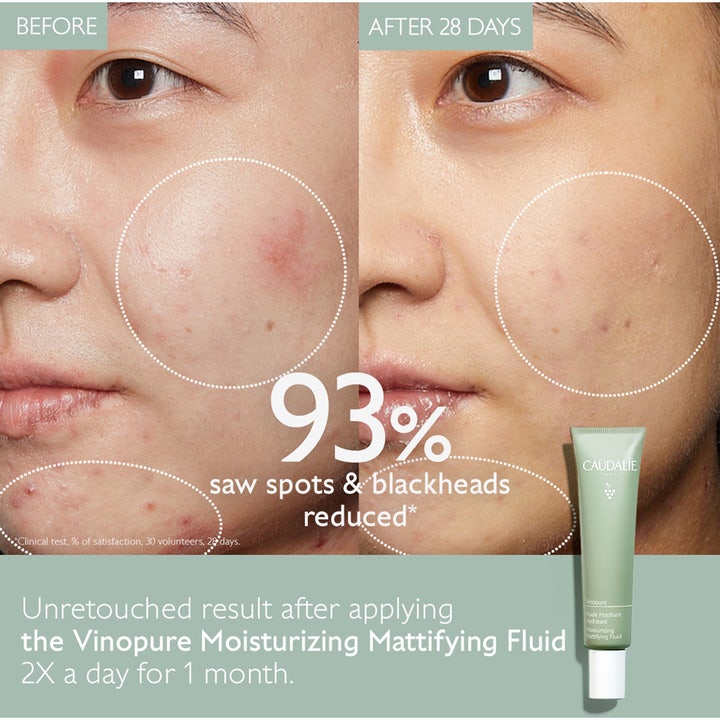 Caudalie Vinopure Moisturizing Mattifying Fluid 40 ml mattende ansiktskrem viser før og etter reduksjon av urenheter