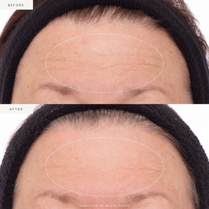 KORA Organics Plant Stem Cell Retinol Alternative Serum 30 ml før og etter bilder som viser glattere hud i pannen