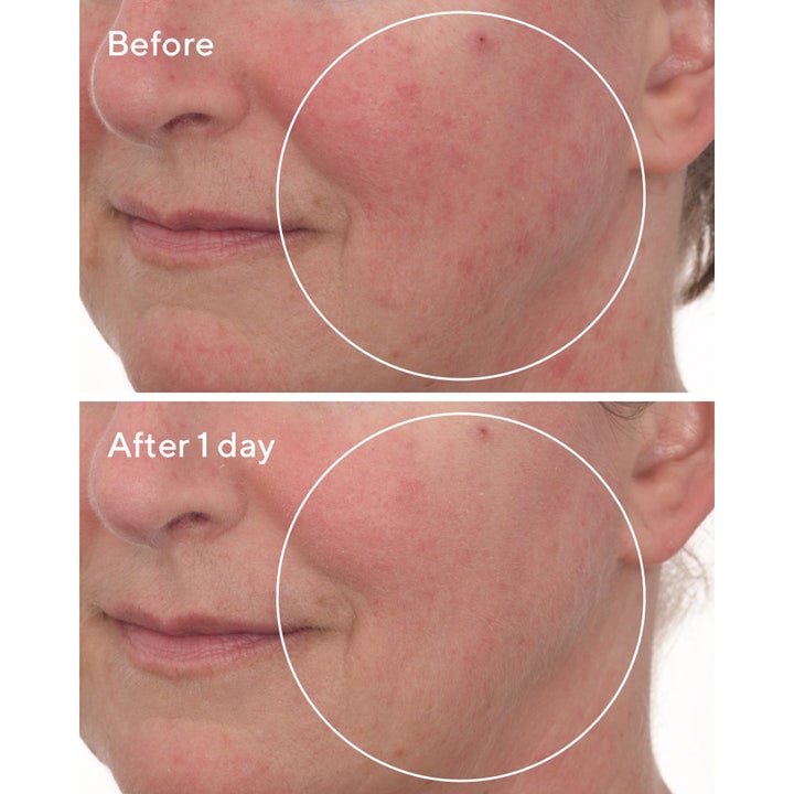 Murad Cellular Hydration Repair Mask 80 ml ansiktsmaske før og etter bilde viser mindre rødhet i huden etter en dag.