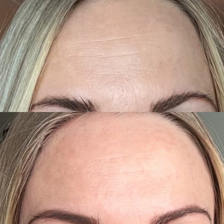 Dana Nel Facial Beauty Tape 1 stk hudpleieverktøy viser før og etter resultat med synlig færre rynker i pannen.