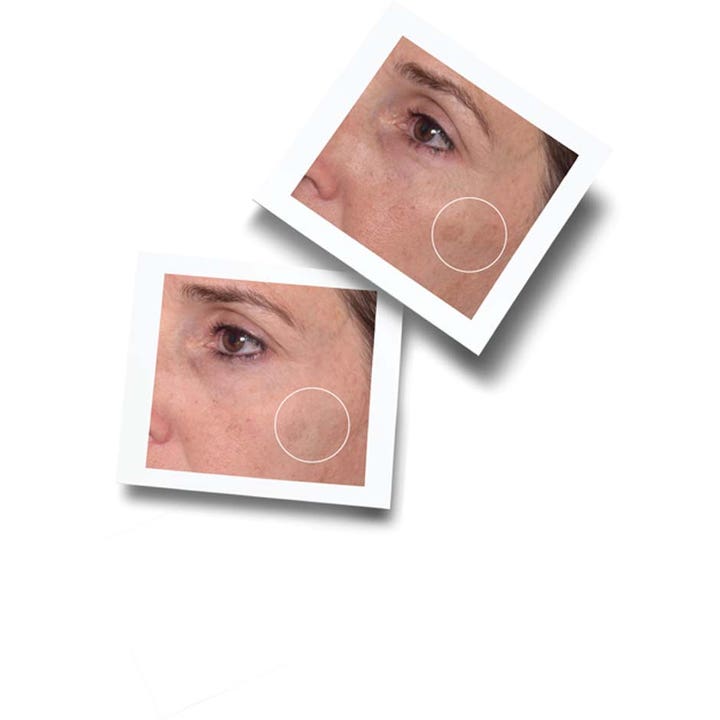 Murad Rapid Dark Spot Correcting Serum 30 ml før og etter bilder som viser reduksjon av pigmentflekker.