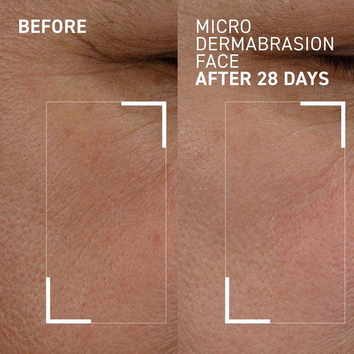 Dr Brandt Microdermabrasion Face 60 g peeling gir glattere hud etter 28 dager vist med før og etter bilder.