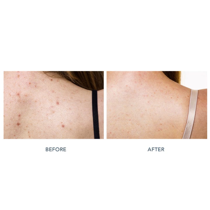 FAQ Swiss FAQ™ 211 LED Neck & Décolleté Mask 1 stk gir jevnere hudtone vist gjennom før og etter resultat på huden.