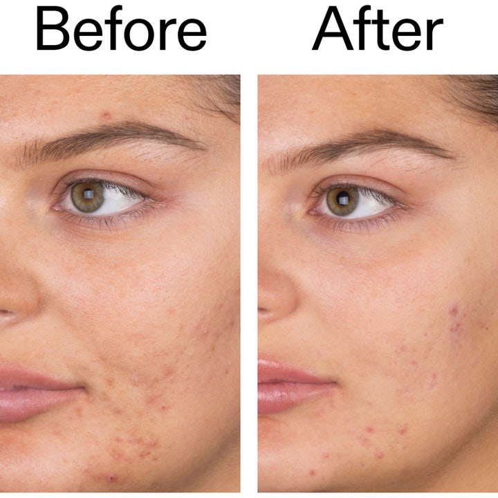 Salicylic Acid Cleanser