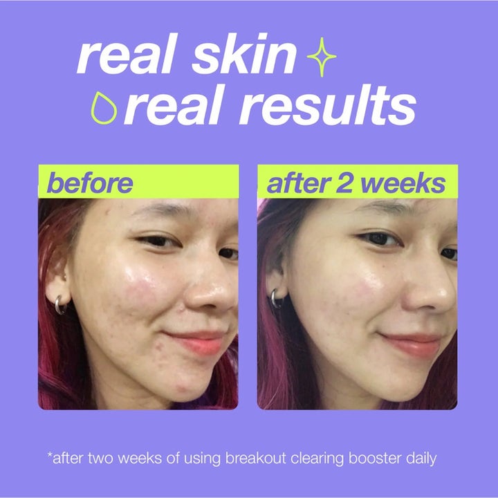 Dermalogica Clear Start Booster Set hudpleie mot kviser viser før og etter bilder av hud med mindre urenheter etter to uker